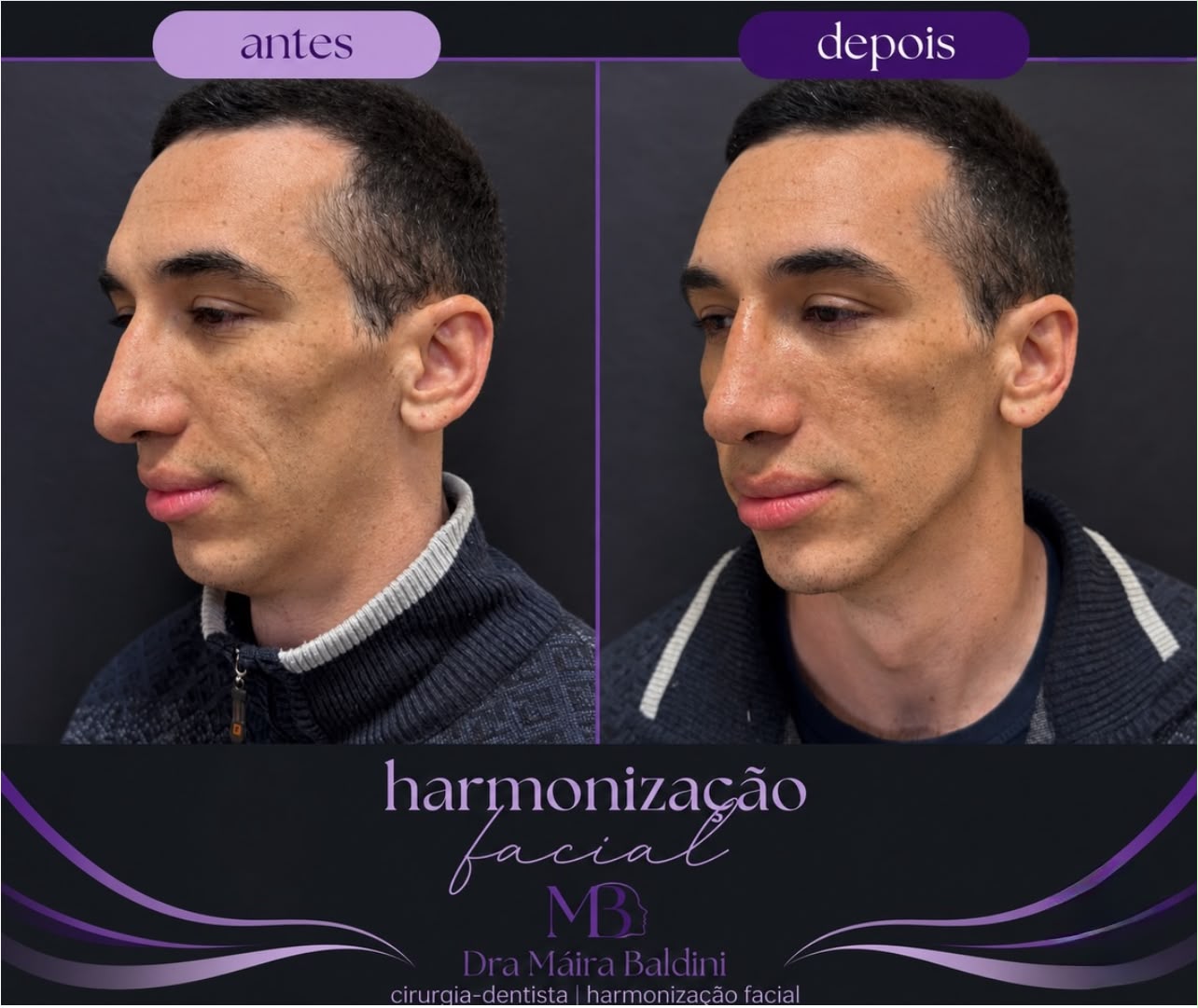 Antes e depois — Harmonização Facial