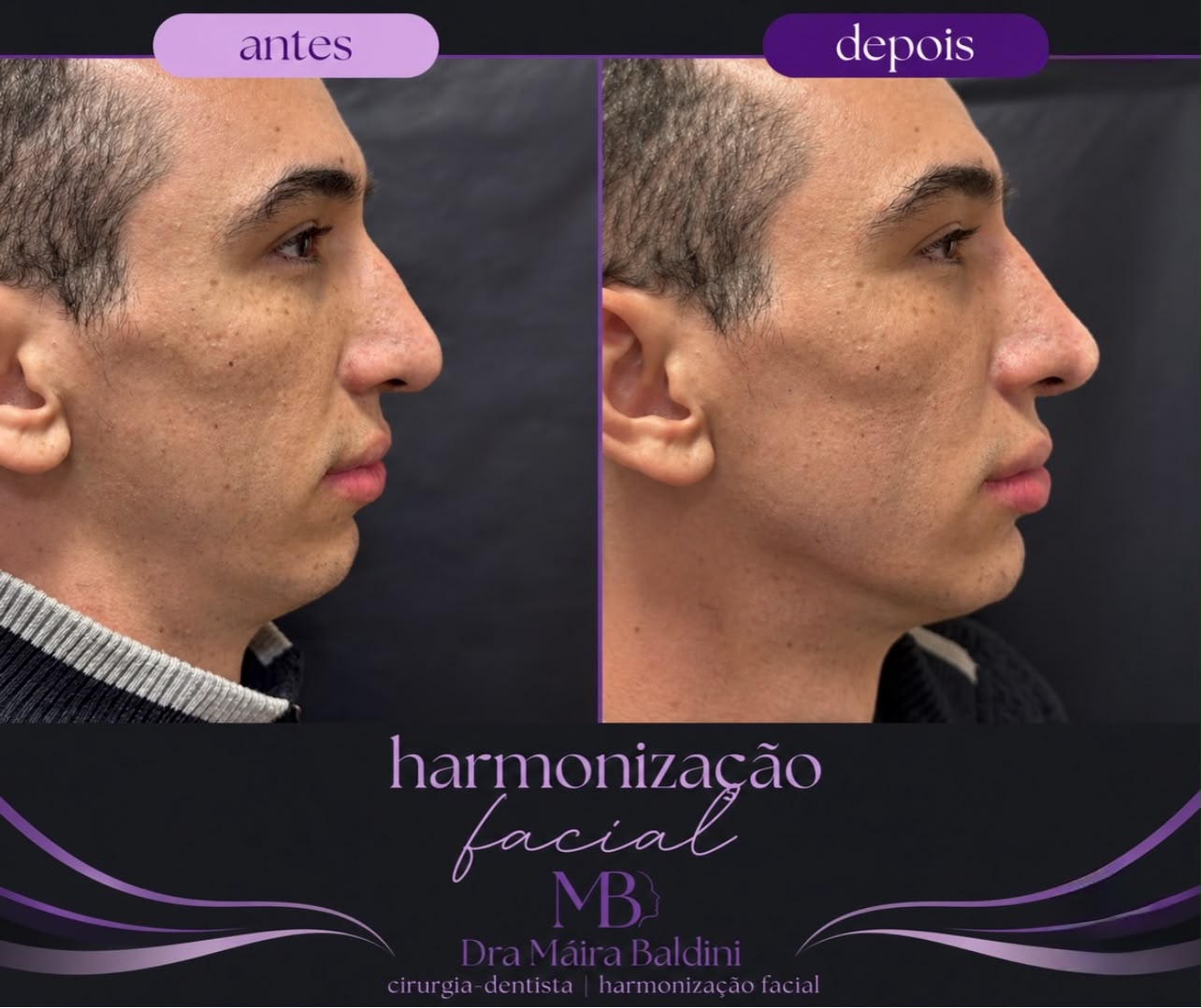 Antes e depois — Harmonização Facial