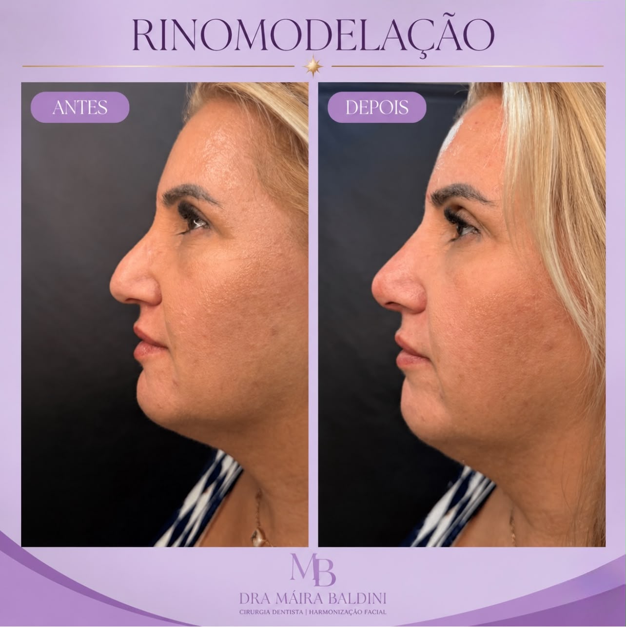 Antes e depois — Rinomodelação