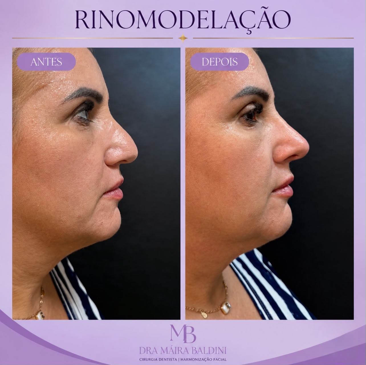 Antes e depois — Rinomodelação